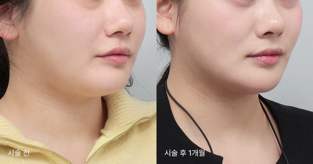 울쎄라의 효과는?
