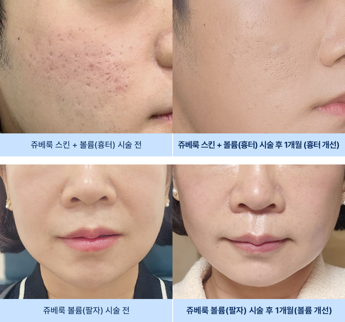 쥬베룩 시술 목적 및 효과
