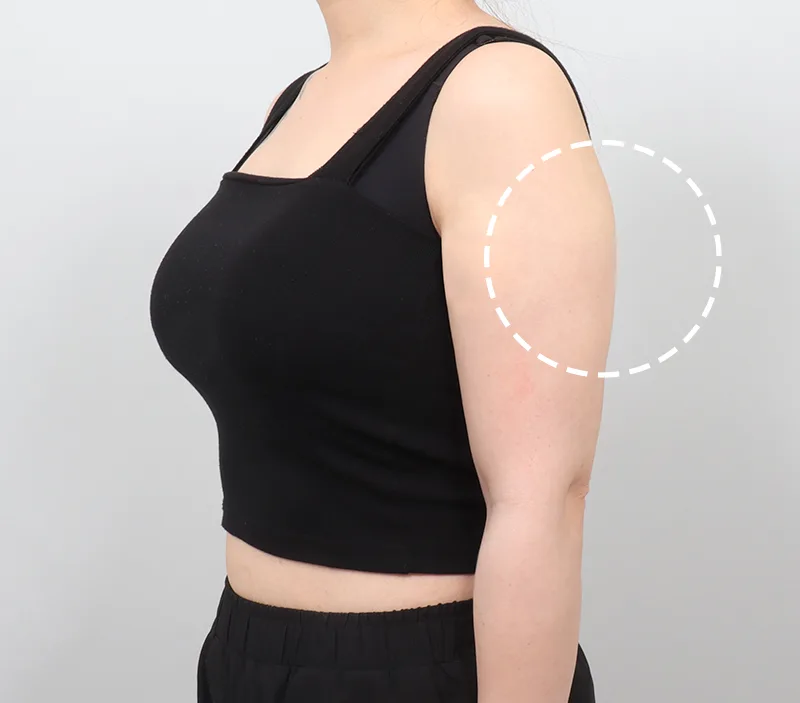 바디 에이빼주사 시술 전