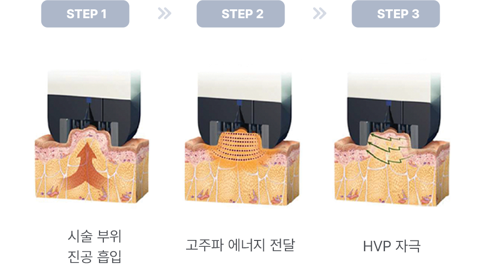 인모드 FX 시술 3단계 과정