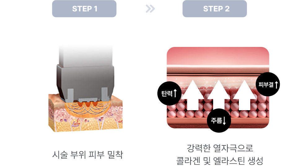 인모드 FORMA 시술 3단계 과정