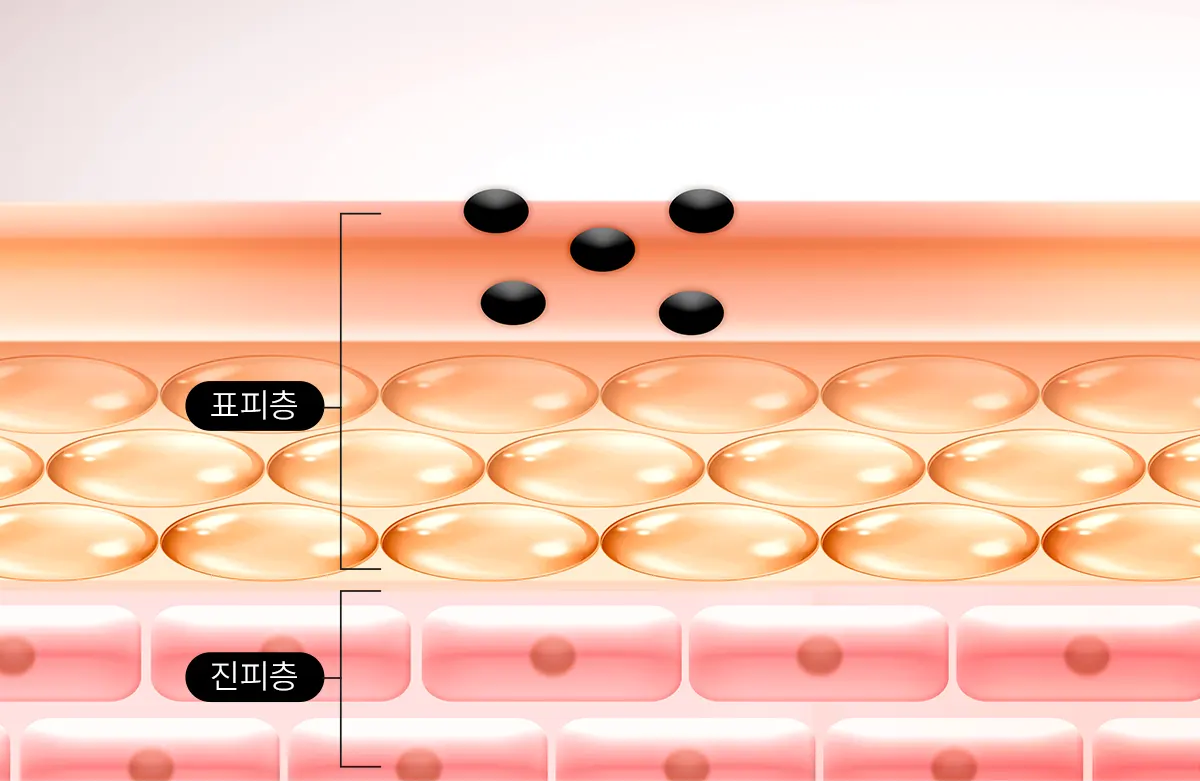 표피에 위치한 색소침착