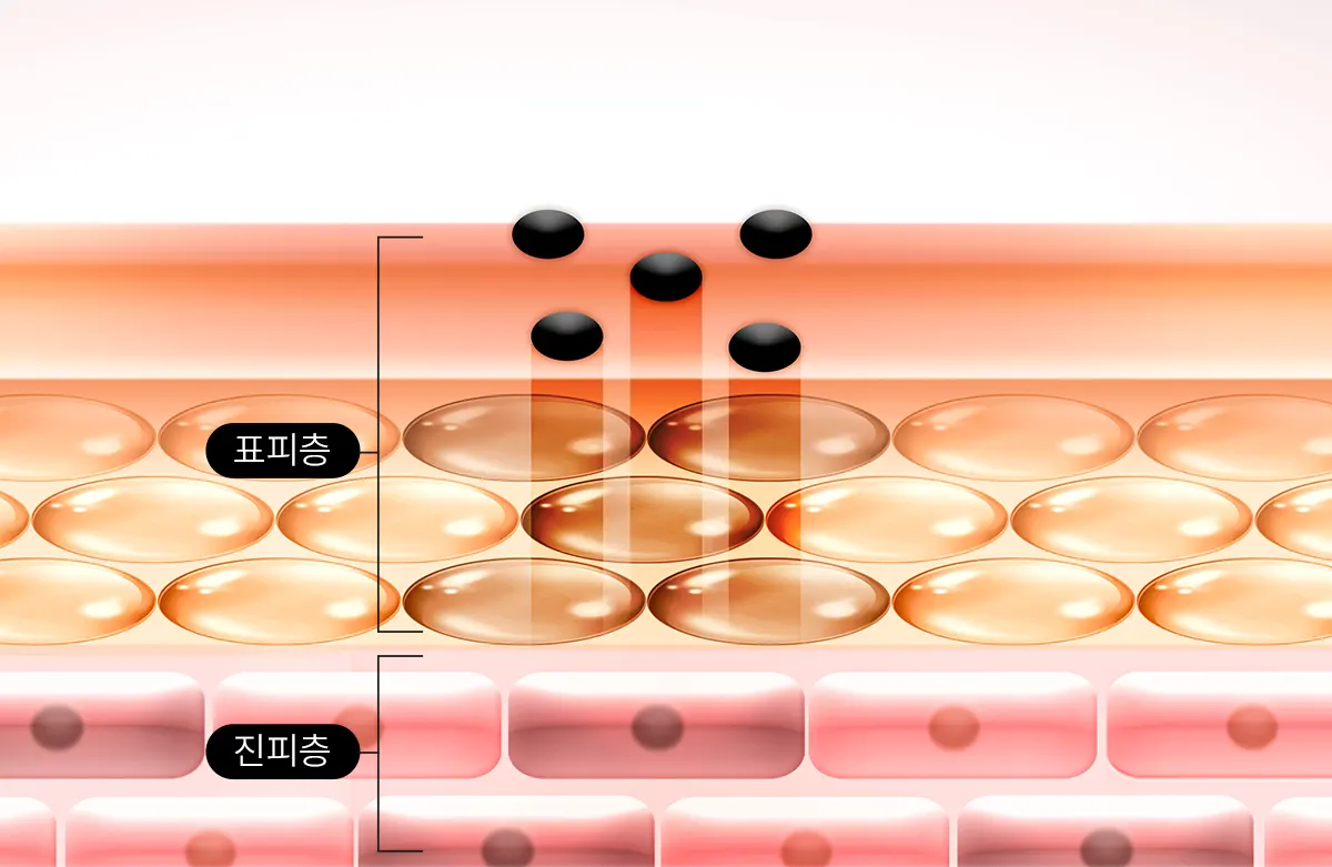 진피와 표피에 위치한 색소침착