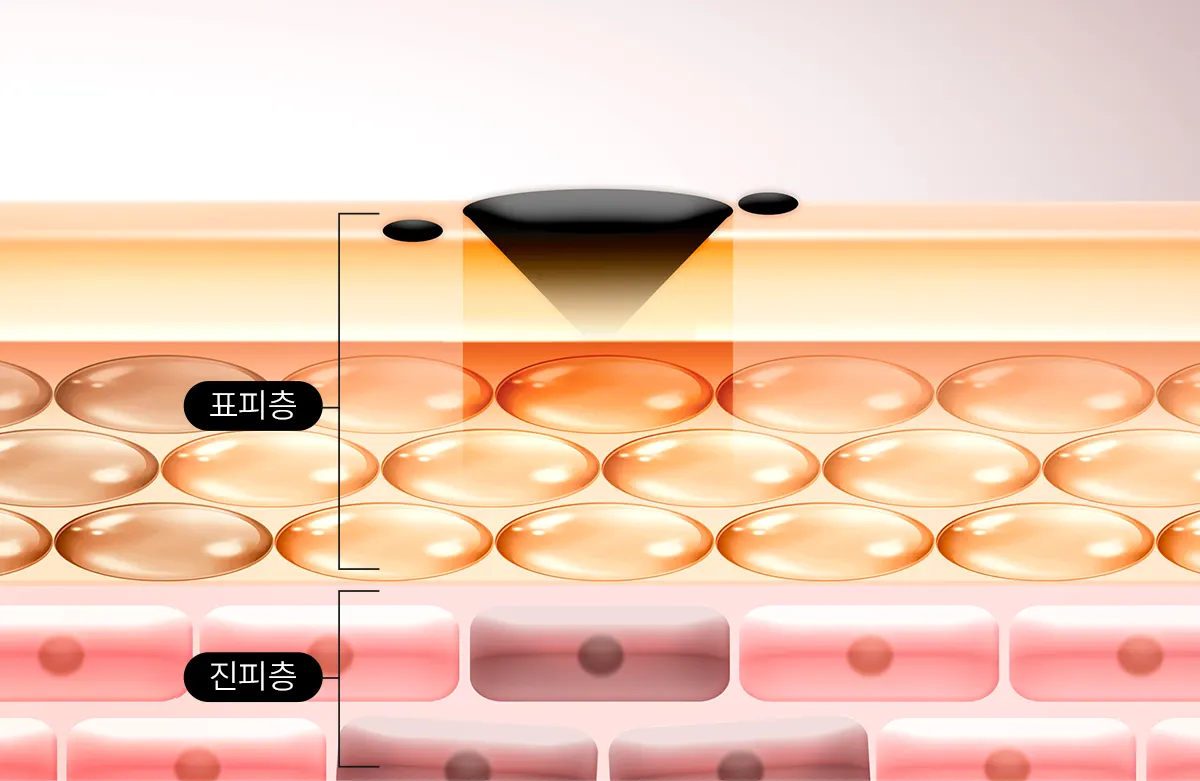 진피에 위치한 색소침착