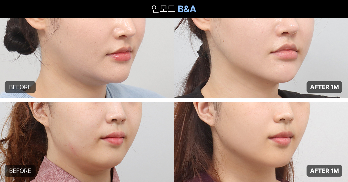 인모드 기대 효과: 어떤 변화가 가능한가