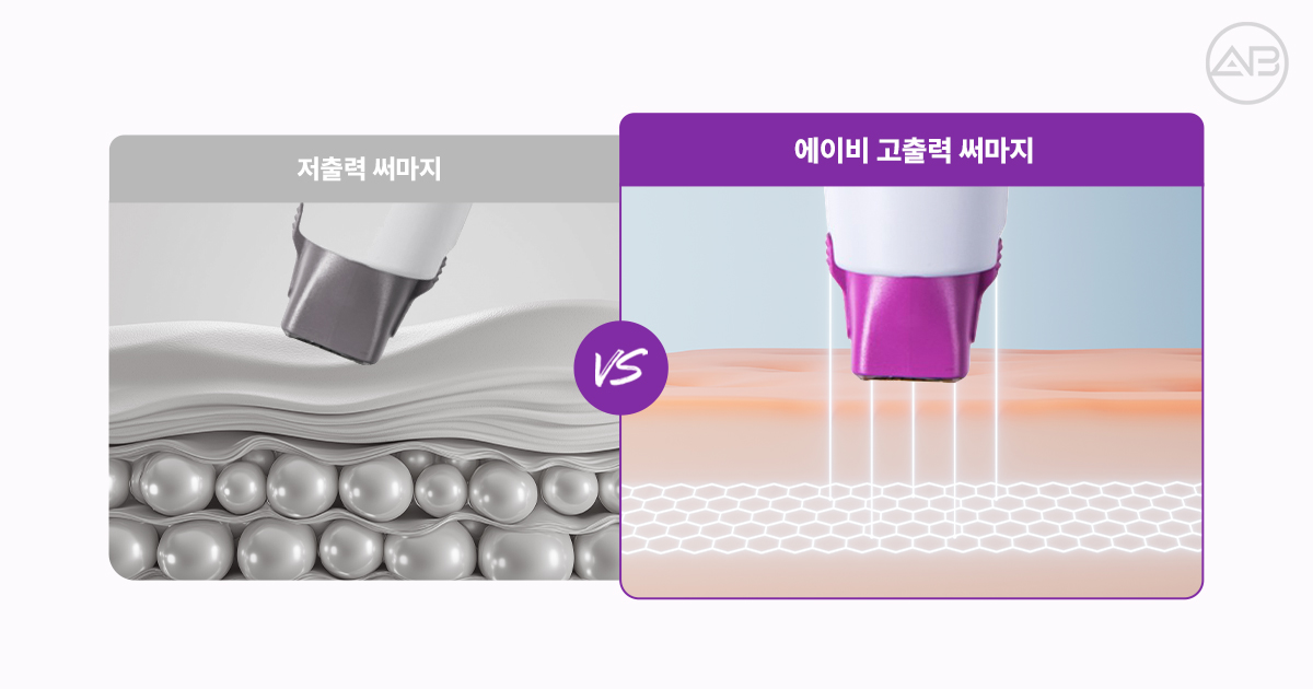 써마지 효과 제대로 보려면 '팁 밀착'이 중요한 이유