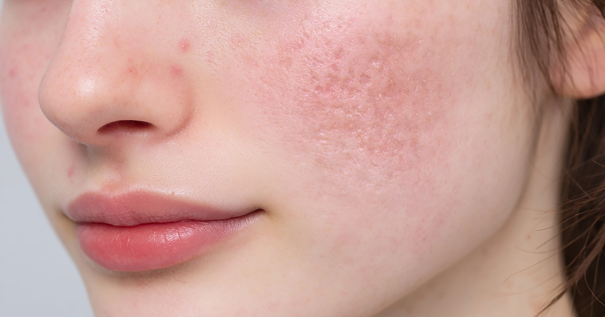 쥬베룩이 여드름 흉터에 효과적인 이유