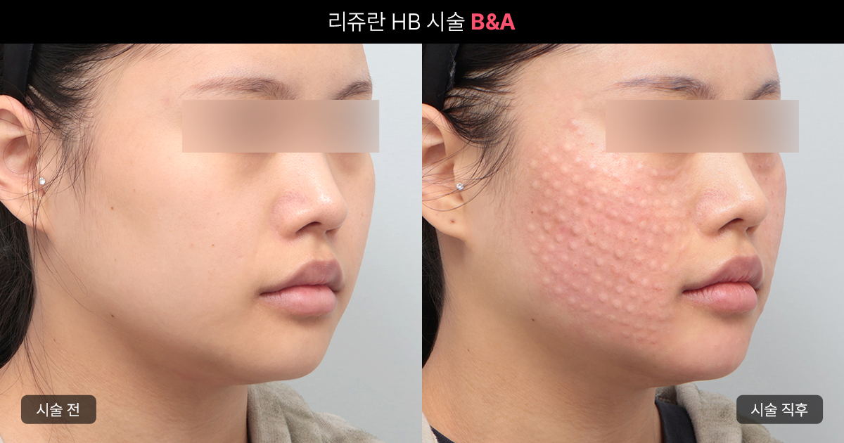 리쥬란 HB는 엠보가 더 오래가는 이유