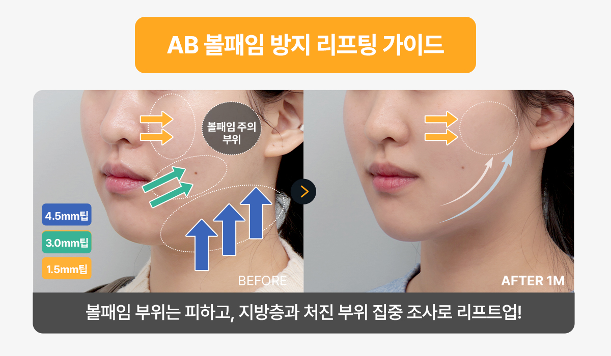 에이비클리닉만의 울쎄라 시술 노하우