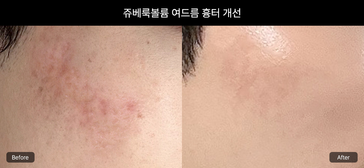 쥬베룩볼륨의 원리와 효과 - 콜라겐 리모델링의 핵심