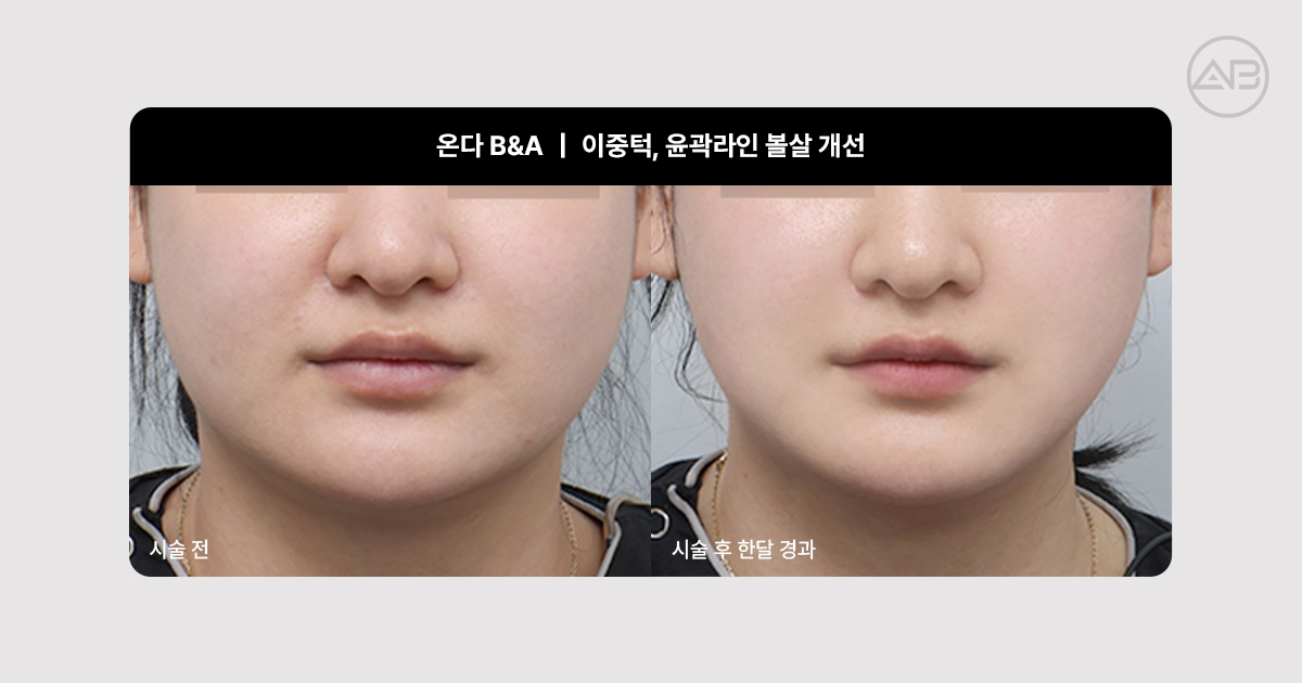 온다리프팅 이중턱, 얼굴살 전후사진｜실제로 어떻게 달라질까요?