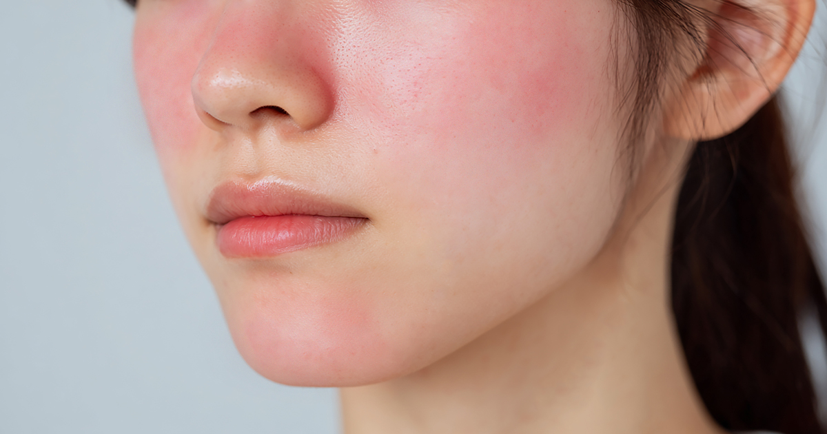 홍조의 근본 원인 