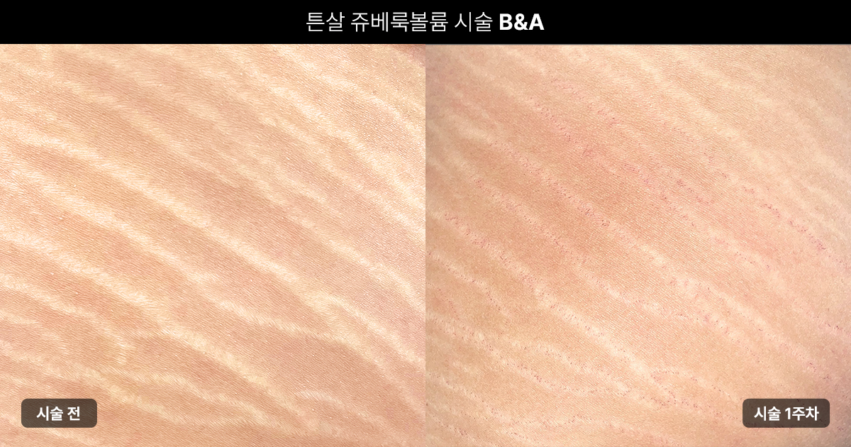 튼살 치료에 쥬베룩볼륨이 효과적인 이유