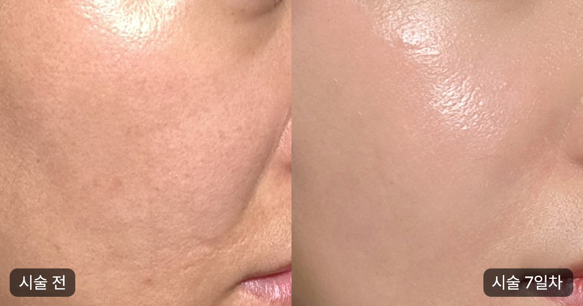 써마지의 기본 원리 및 효과