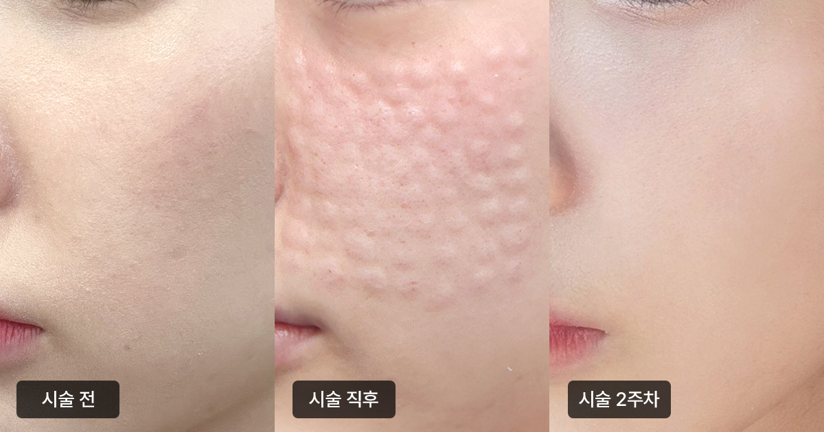 리쥬란힐러 성분 및 효과