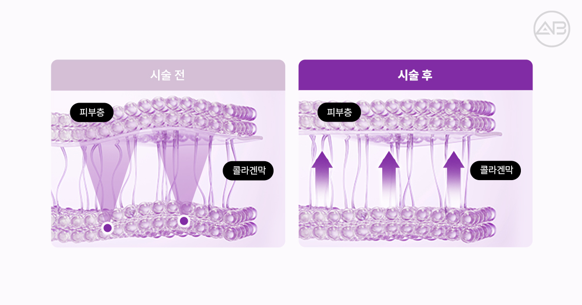 써마지 시술원리, 효과를 위해서 고출력이 중요한 이유