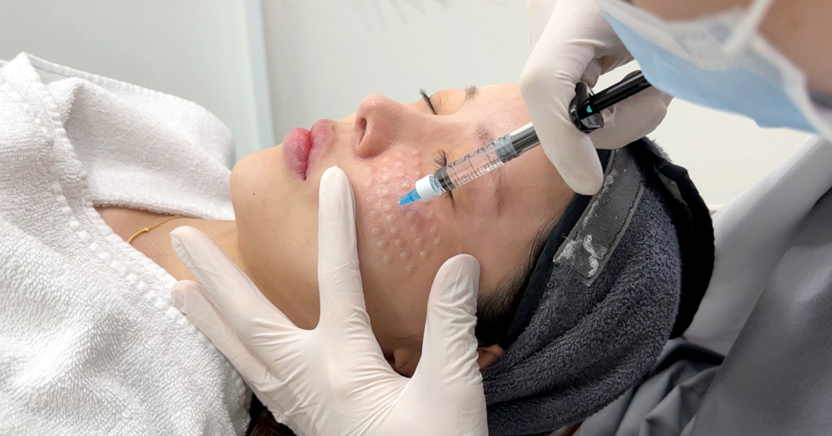 리쥬란 시술 후 엠보 현상이 올라오는 이유 관련 이미지