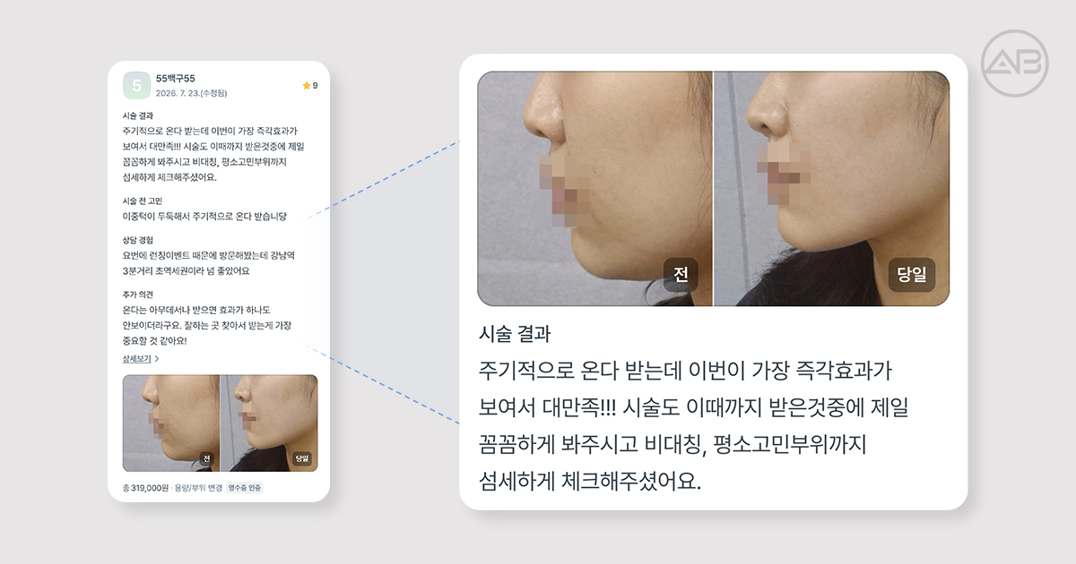 실제 온다리프팅 후기로 보는 효과