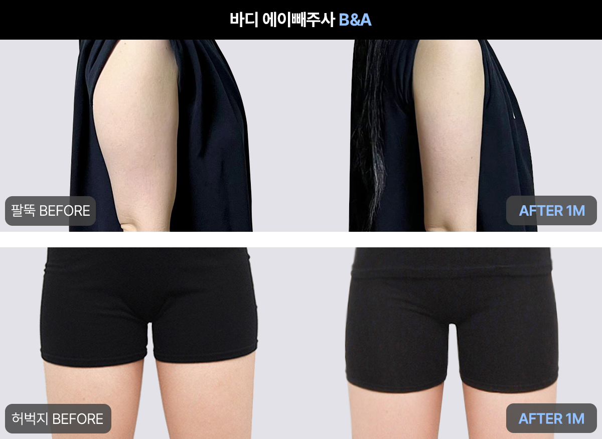 부작용 성분을 빼 안전하고 효과적인 에이빼 지방분해주사