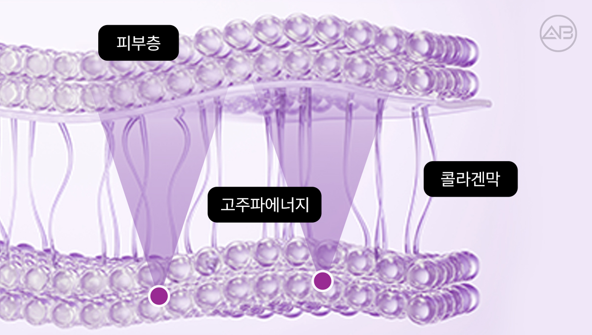 써마지 효과를 위해선 왜 샷 수보다 시술 설계가 더 중요할까요?