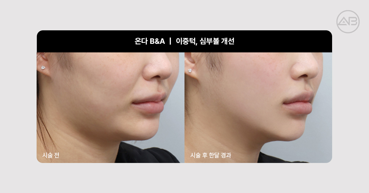 온다리프팅 이중턱, 심부볼 전후사진｜실제로 어떻게 달라질까요?