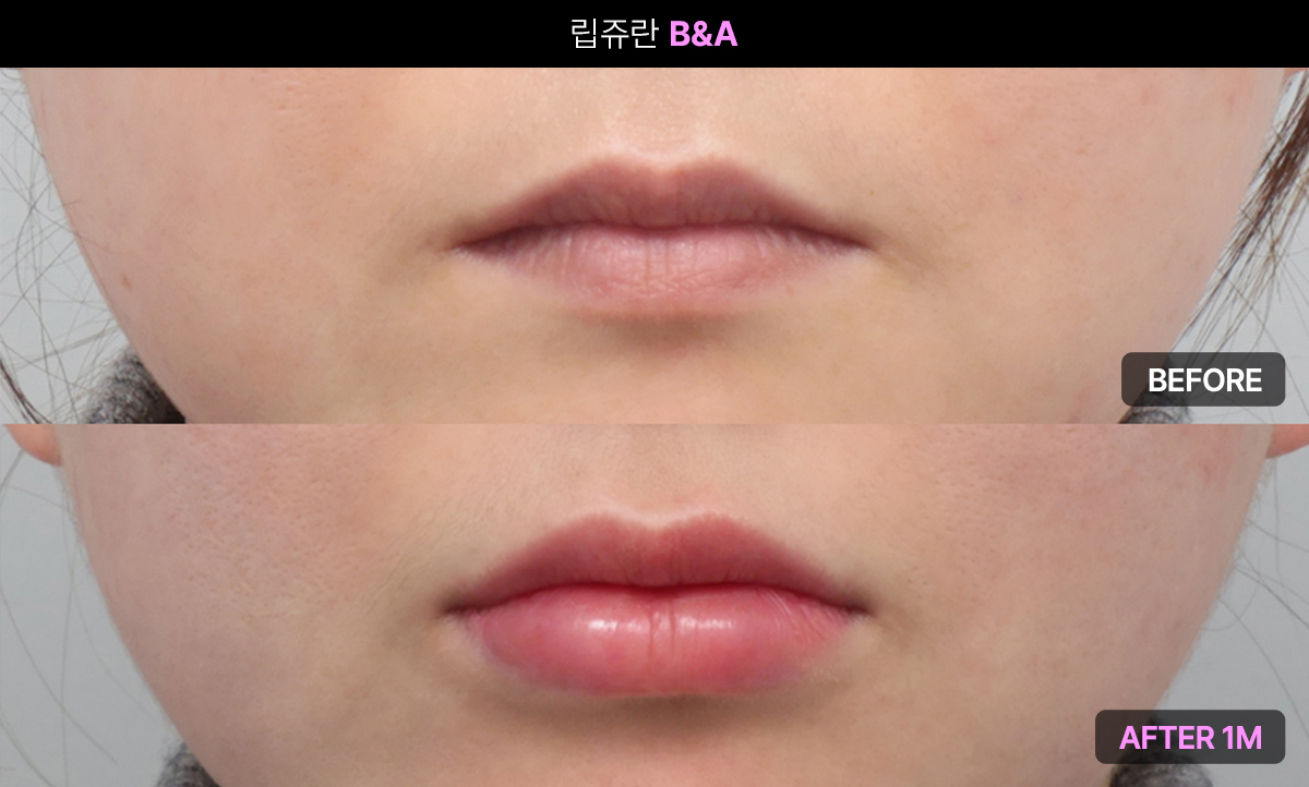 입술에 적용하는 스킨부스터, 립쥬란 효과