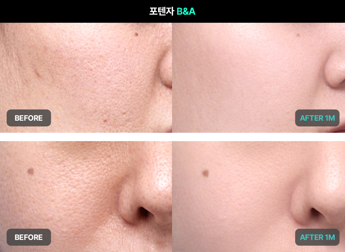 포텐자 후 효과 알아보기