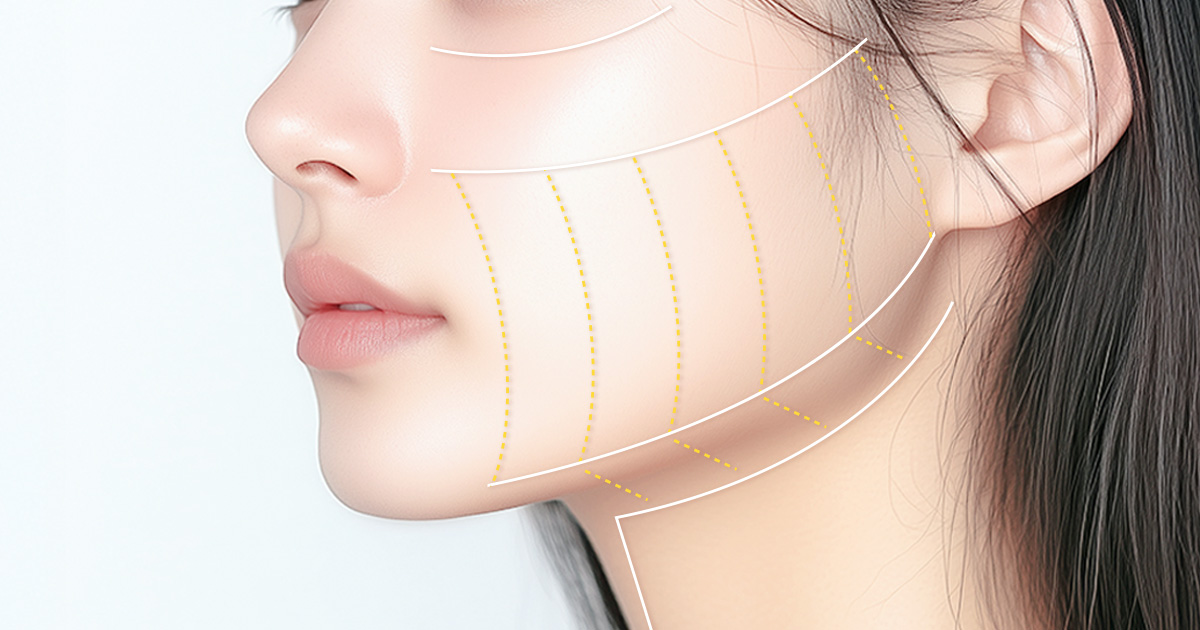 울쎄라 효과, 얼굴 디자인에 따라 달라진다? 리프팅 결과를 결정하는 핵심 포인트 관련 이미지