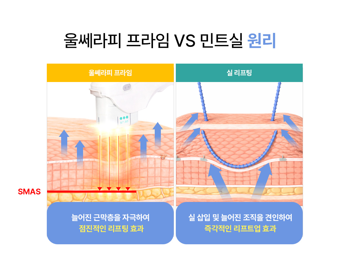 울쎄라 리프팅과 실리프팅의 원리 차이