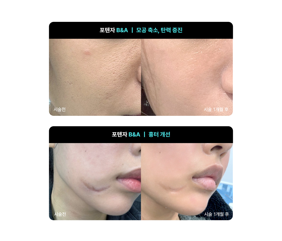 포텐자 모공팁 vs 펌핑팁, 어떤 효과 차이가 있을까요?
