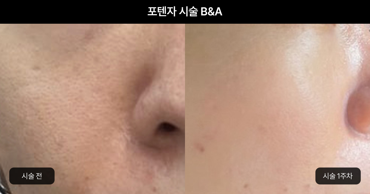 모공 개선에 효과적인 작용 원리