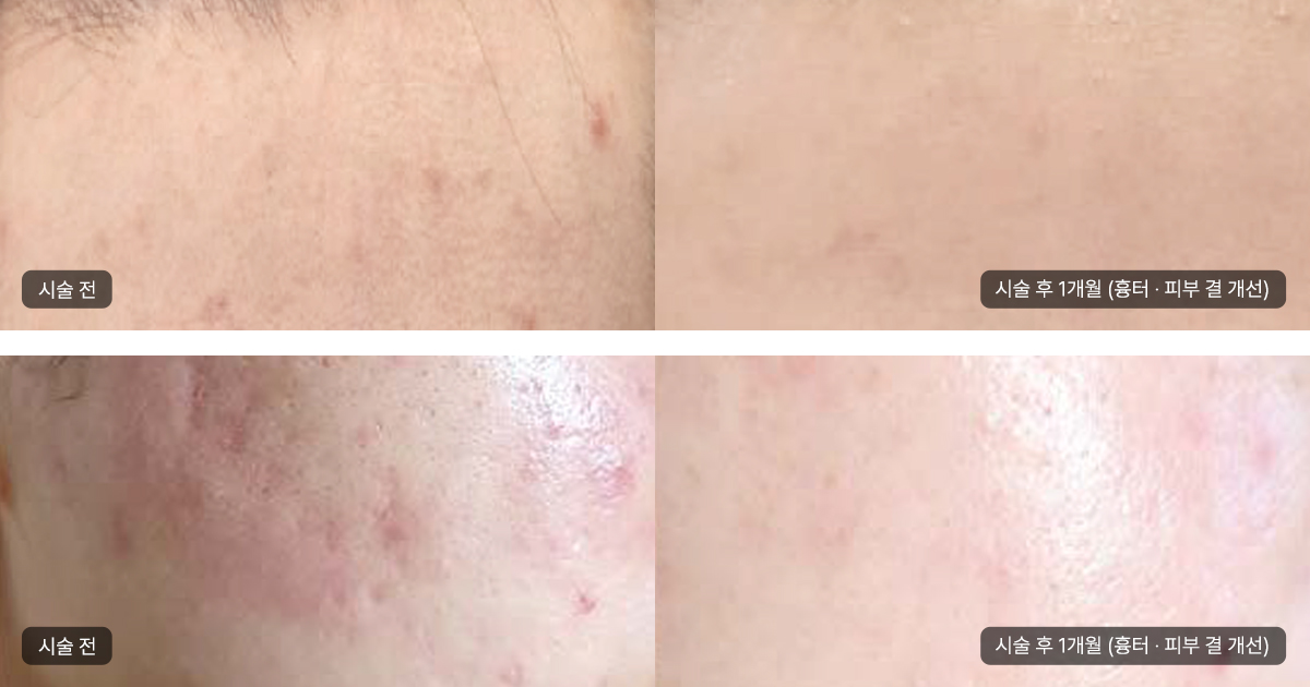 레스노베 크리스탈 시술 대상과 기대 효과