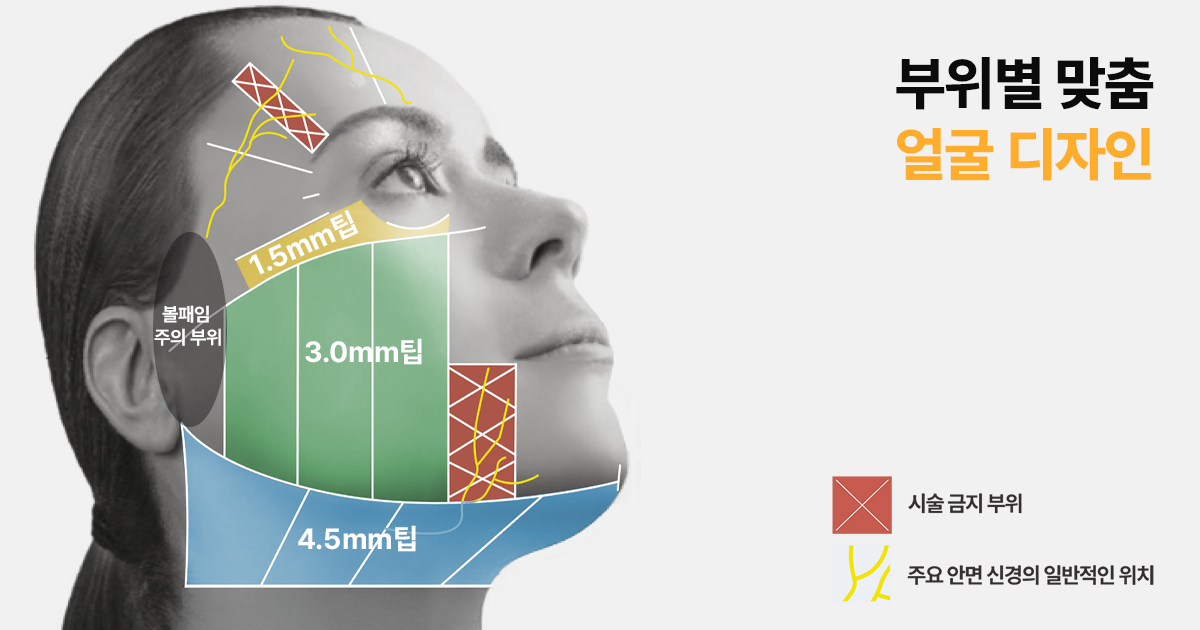 울쎄라, 얼굴 디자인과 정풉 팁 사용이 필요한 이유