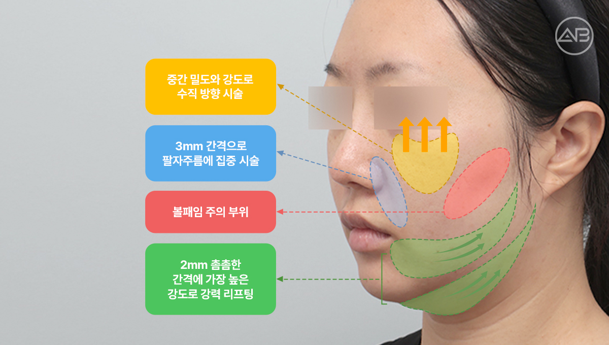 울쎄라 효과, 아플수록 좋을까요?