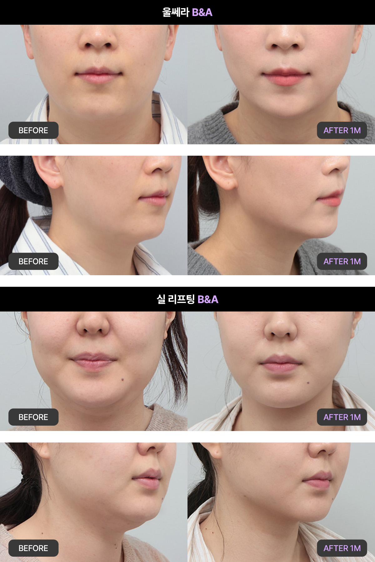 울쎄라vs실리프팅 효과와 얼굴 유형에 따른 추천 대상