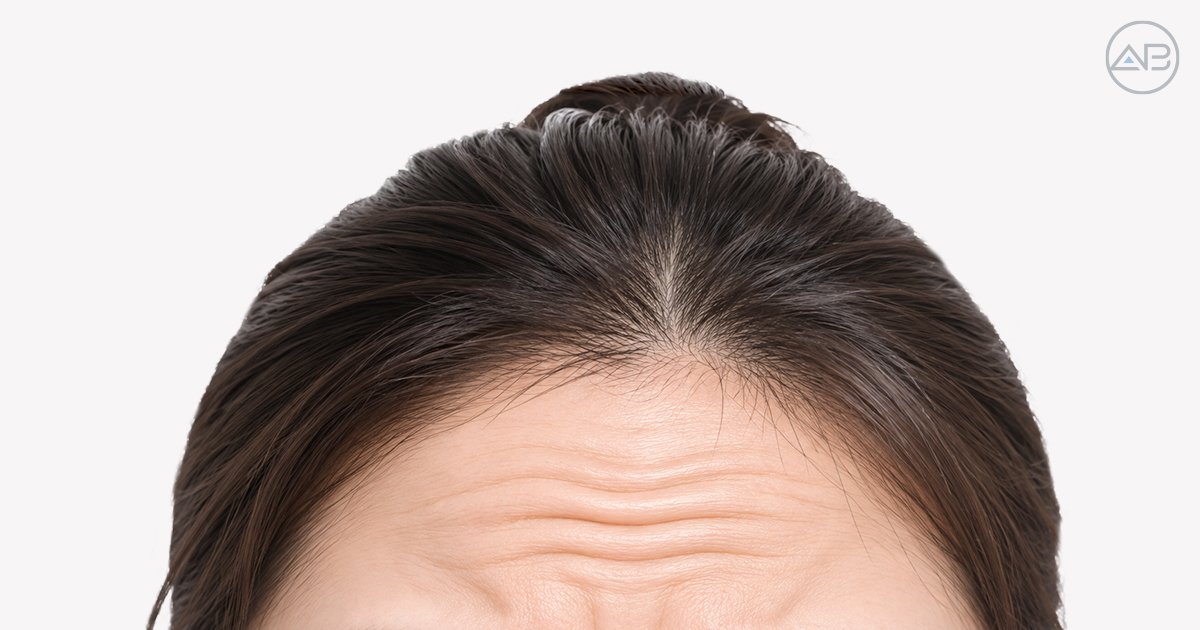 가만히 있어도 보이는 주름, 왜 보톡스만으로 부족할까요?