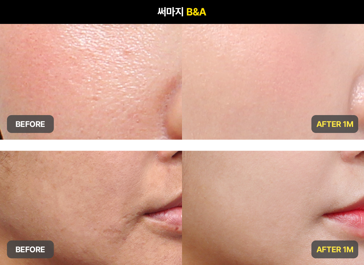 써마지 효과가 만들어지는 원리와 가장 좋은 시술 타이밍