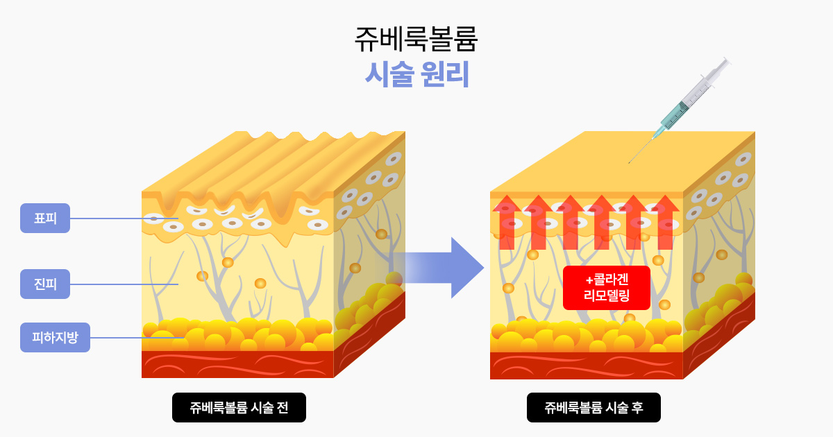 쥬베룩볼륨이 함몰된 여드름 흉터에 효과적인 이유