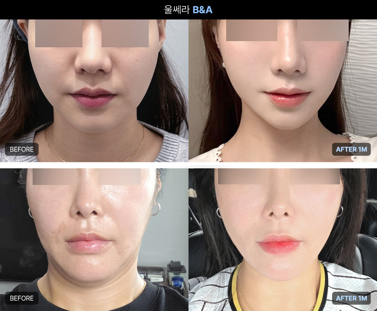 울쎄라의 원리와 기대할 수 있는 효과