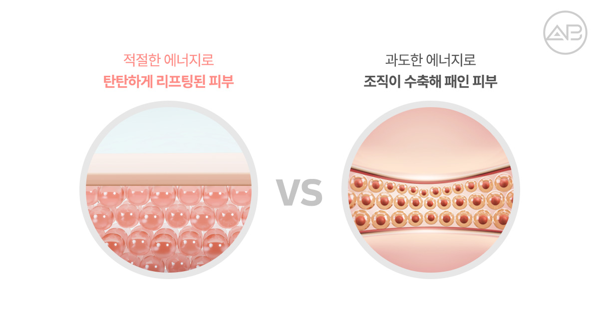 울쎄라 효과, 강하게 받을수록 좋을까요