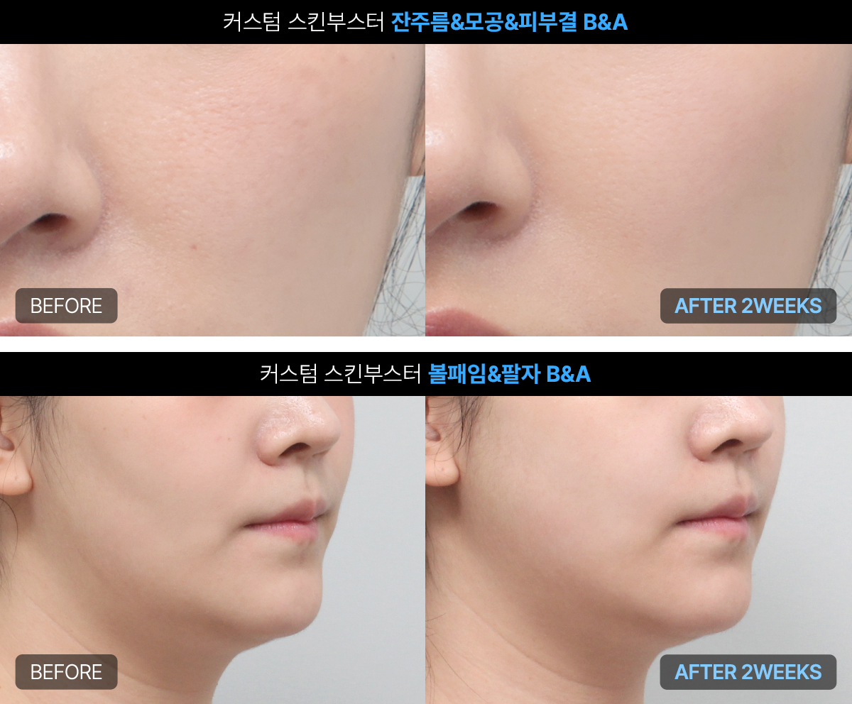 스킨부스터 효과가 사람마다 달라지는 이유