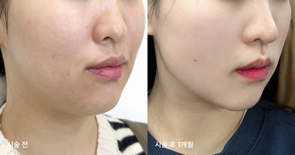 시술 후 관리와 효과 유지 방법