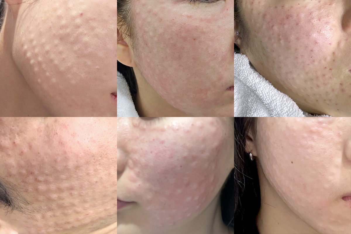 리쥬란 시술에서 엠보의 중요성