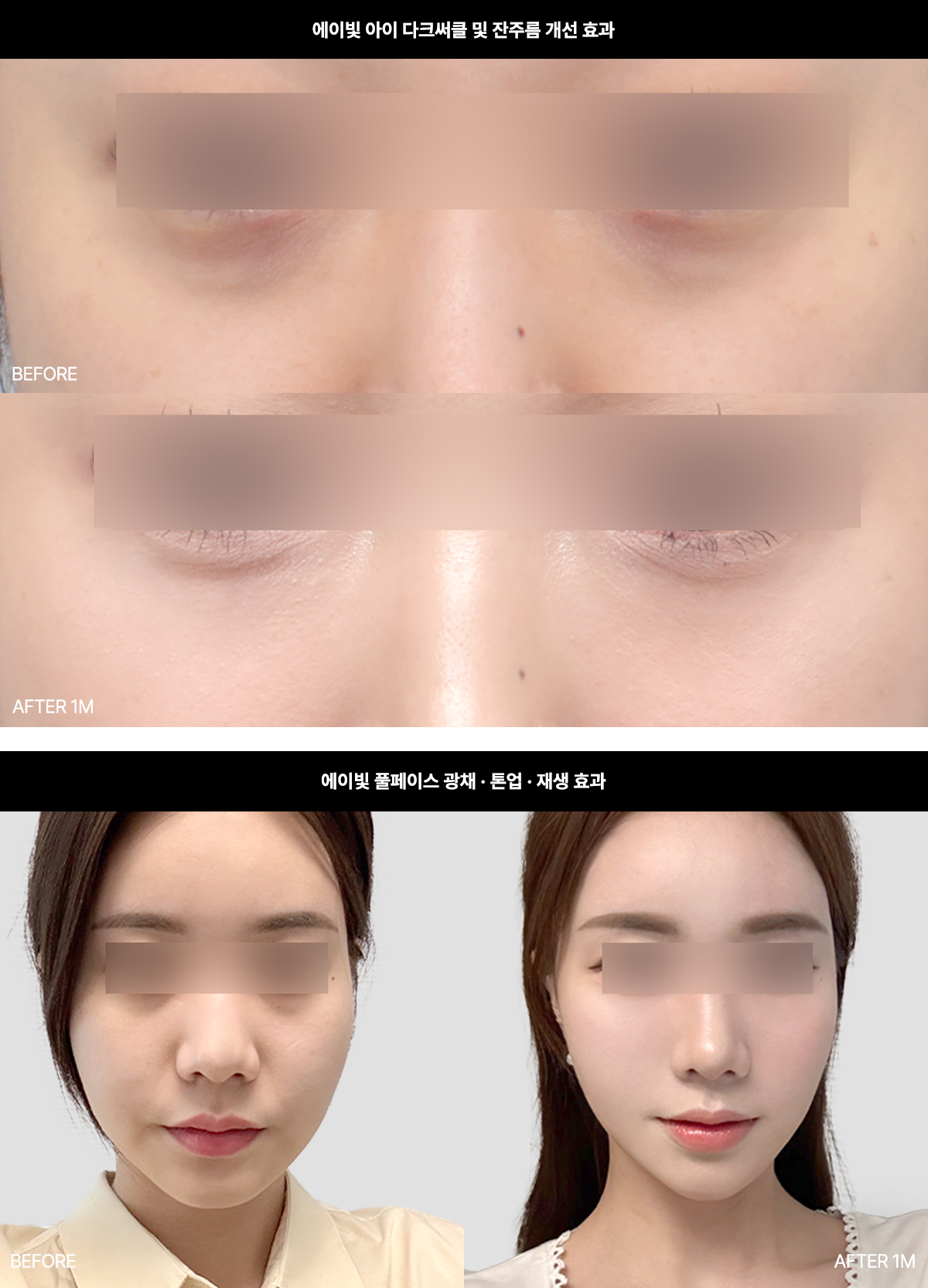 에이빛주사 정의 및 효과