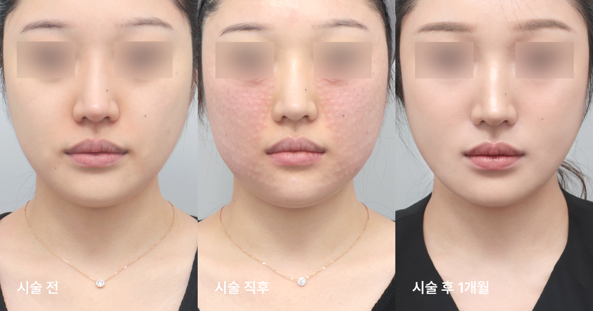 리쥬란의 주요 효과