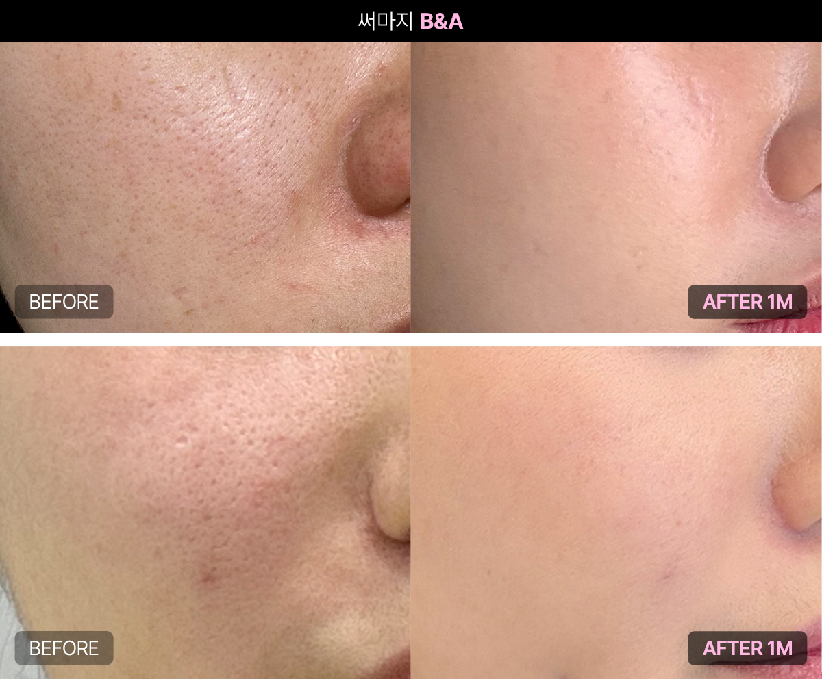 써마지 효과가 잘 나타나는 피부 유형