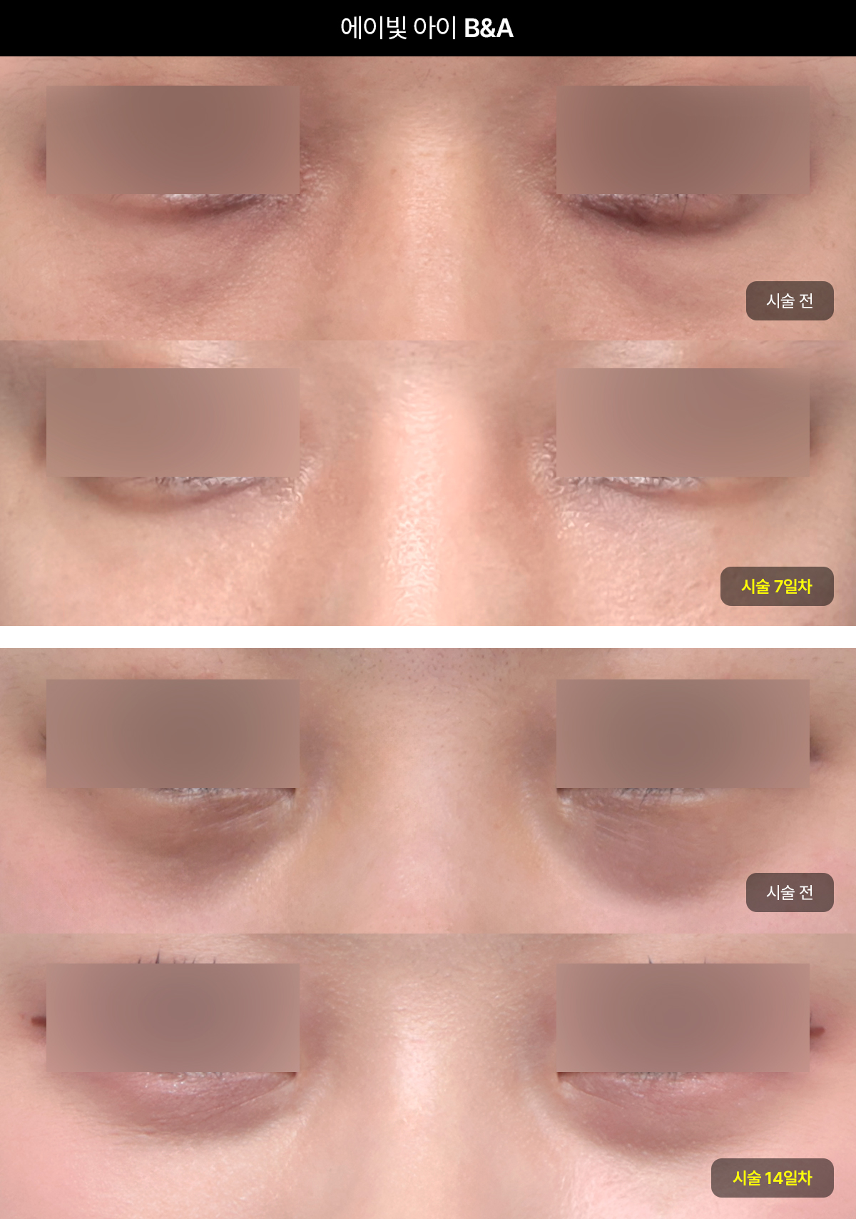 다크서클을 뿌리부터 잡는 에이빛 아이 효과