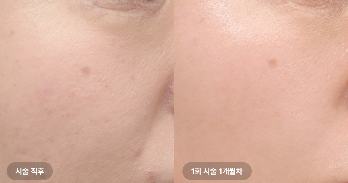 써마지 시술 주기