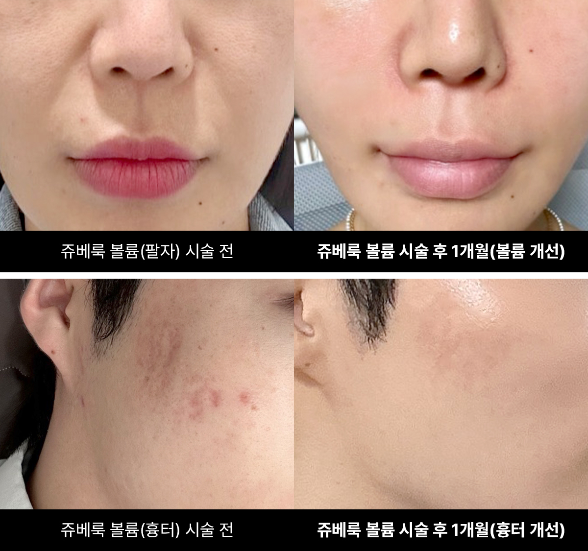 쥬베룩 볼륨 시술 효과