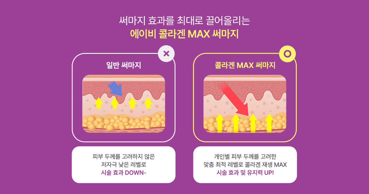 써마지 부작용과 예방 포인트